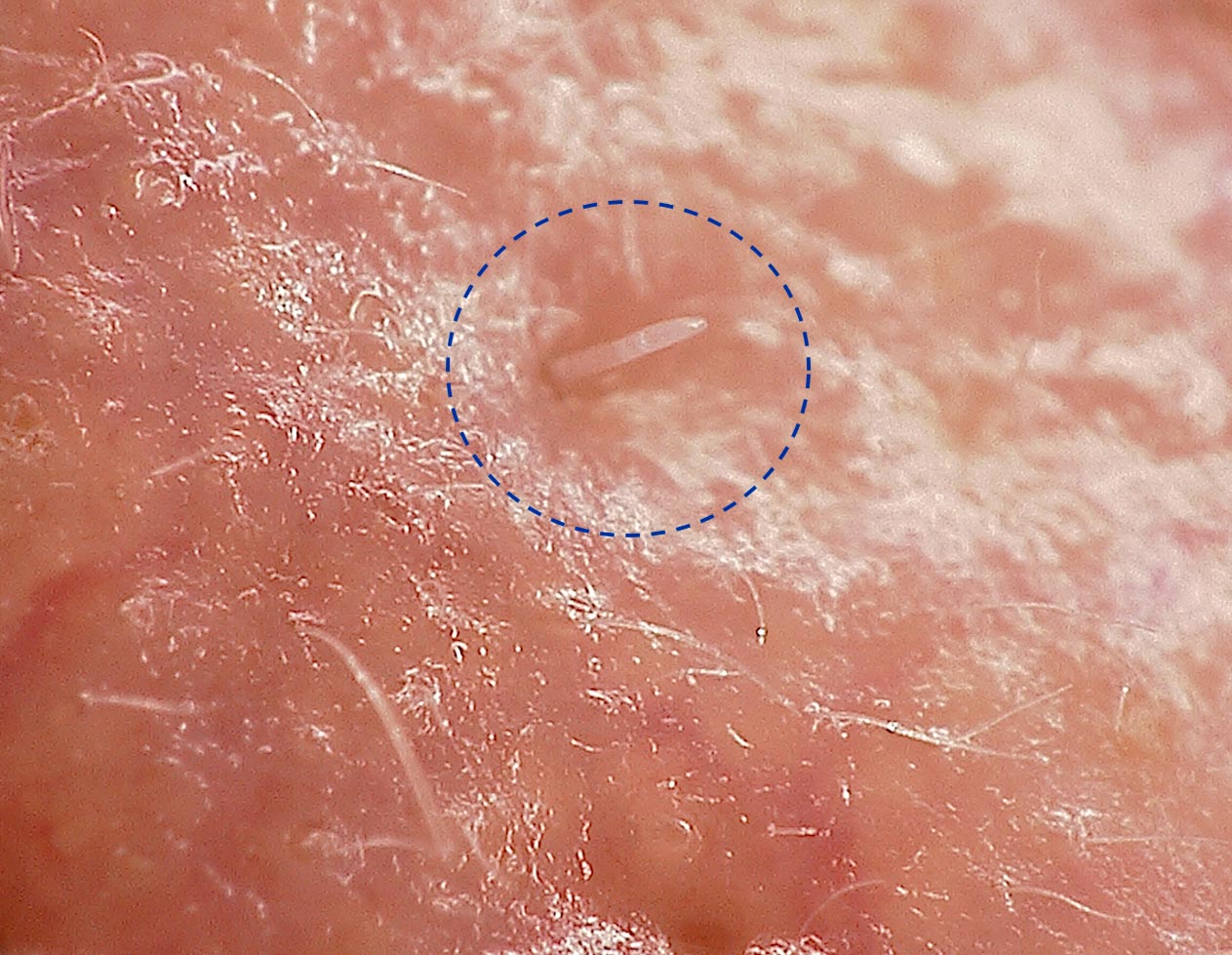 Demodex folliculorum Mite on Skin